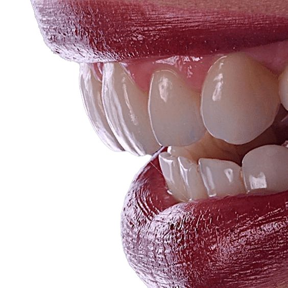 ونیر کامپوزیت دندان