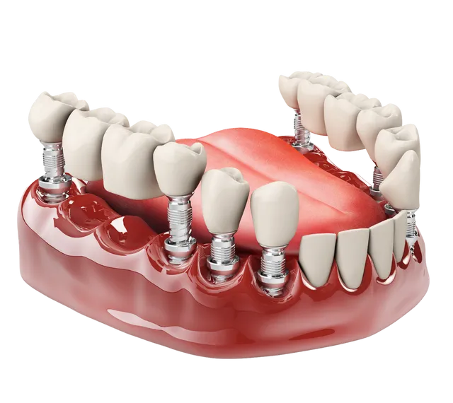 مرکز ایمپلنت دندان در هروی