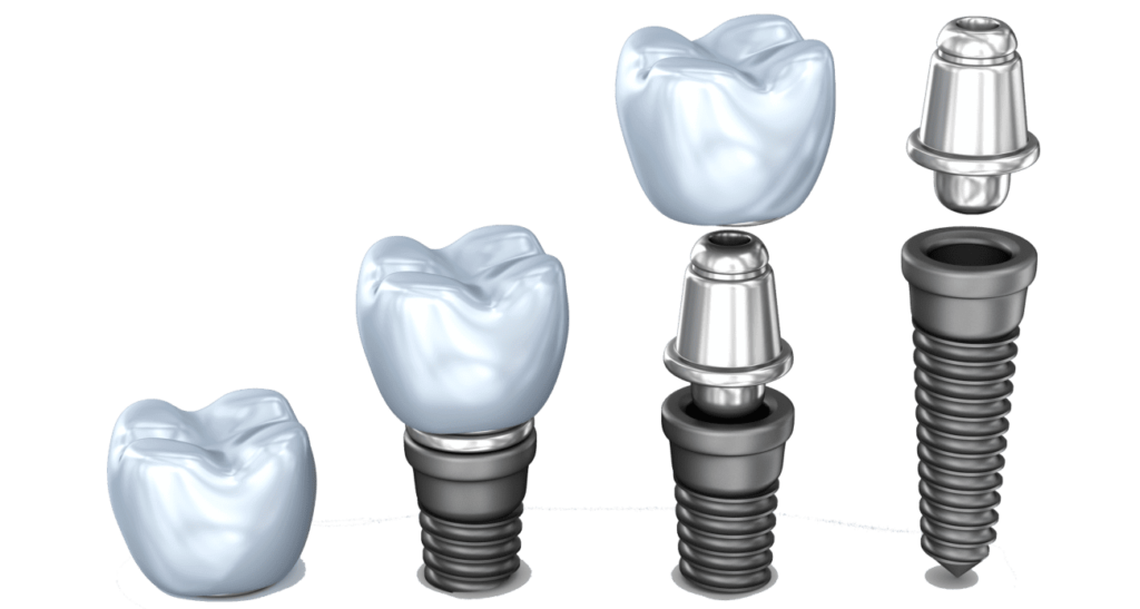 مرکز ایمپلنت دندان در هروی