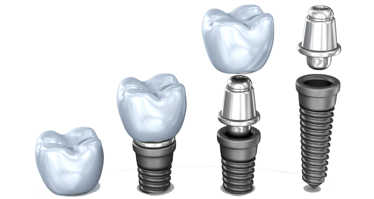 بهترین ایمپلنت دندان پاسداران