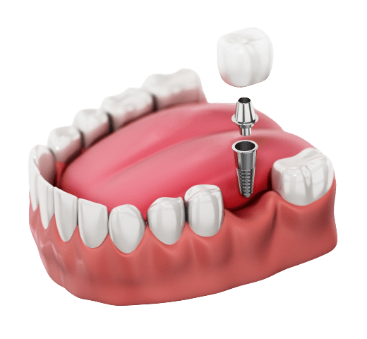 بهترین ایمپلنت دندان شمس آباد