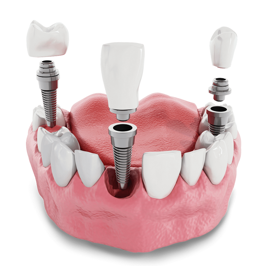 مرکز ایمپلنت دندان در هروی