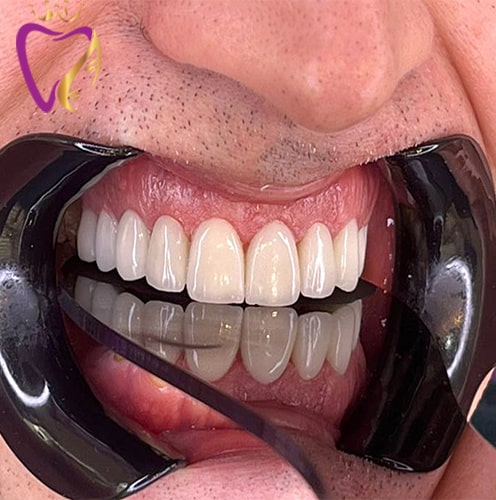 لمینت سرامیکی دندان