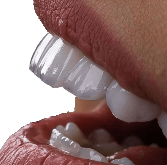 بهترین لمینت دندان