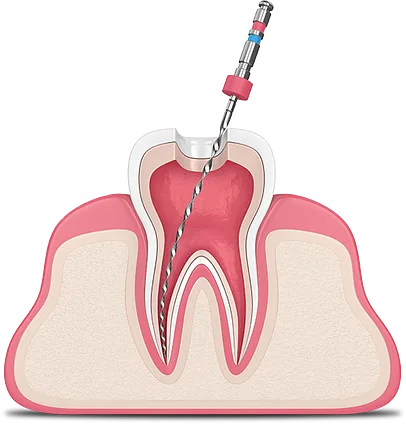 عصب کشی دندان شمس آباد