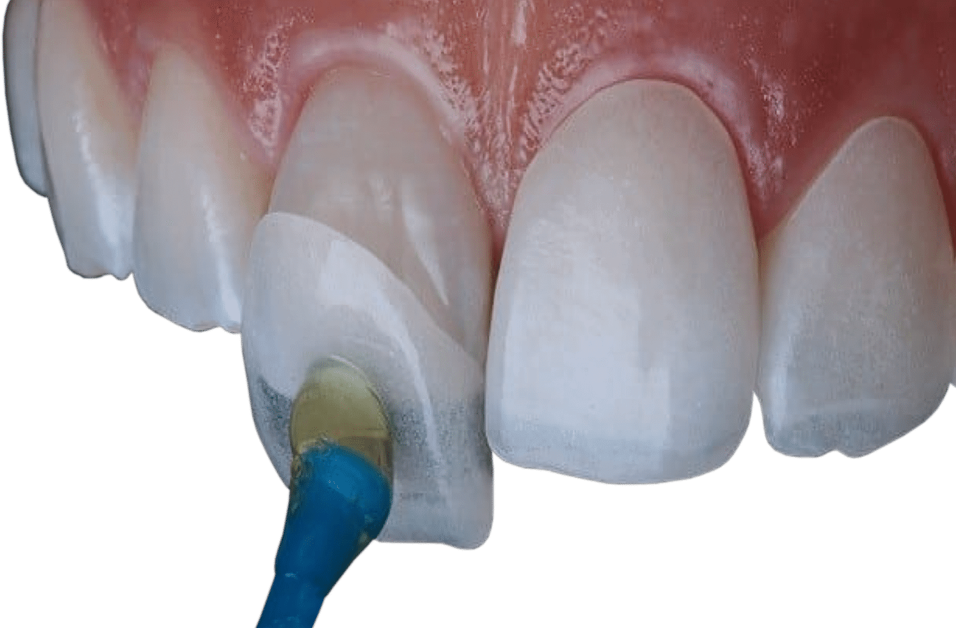 کامپوزیت ونیر دندان