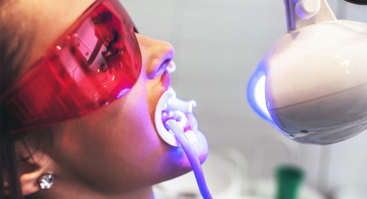 بلیچینگ دندان پاسداران