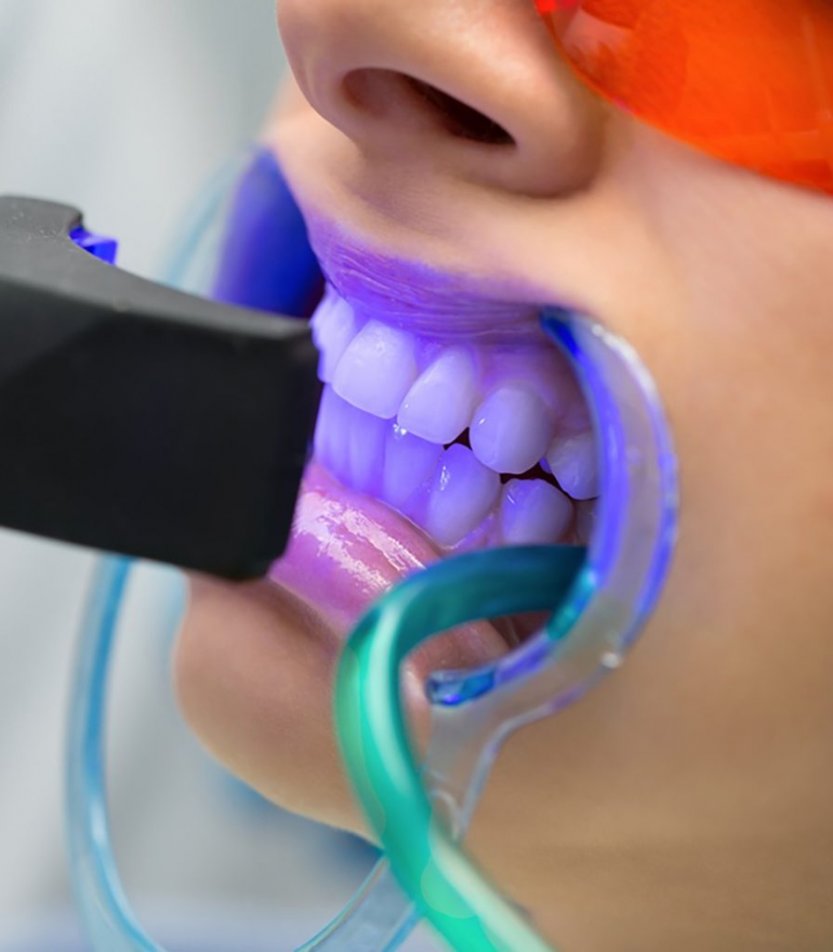 بلیچینگ دندان