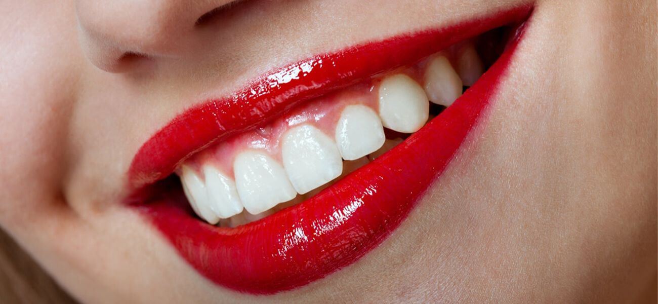 بهترین لمینت دندان پاسداران