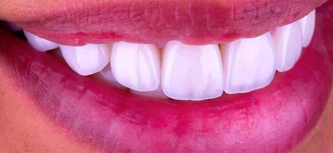 لمینت بدون تراش دندان هروی