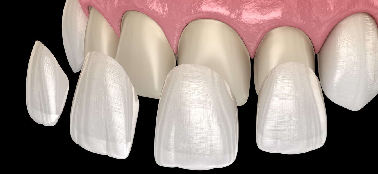 بهترین کامپوزیت دندان شمس آباد