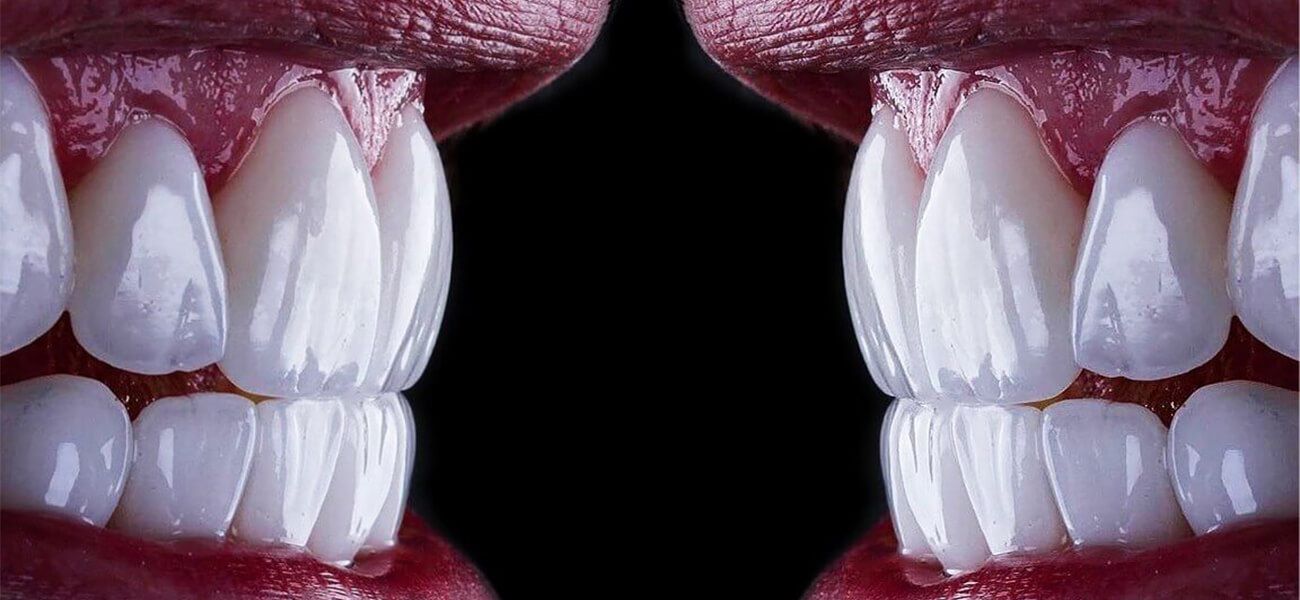 لمینت بدون تراش دندان شمال تهران