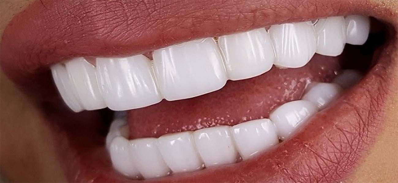 بهترین کامپوزیت دندان