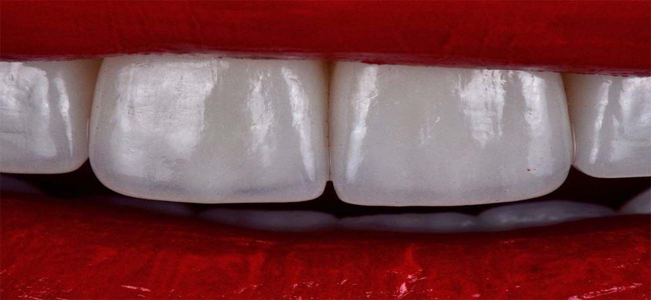 لمینت بدون تراش دندان