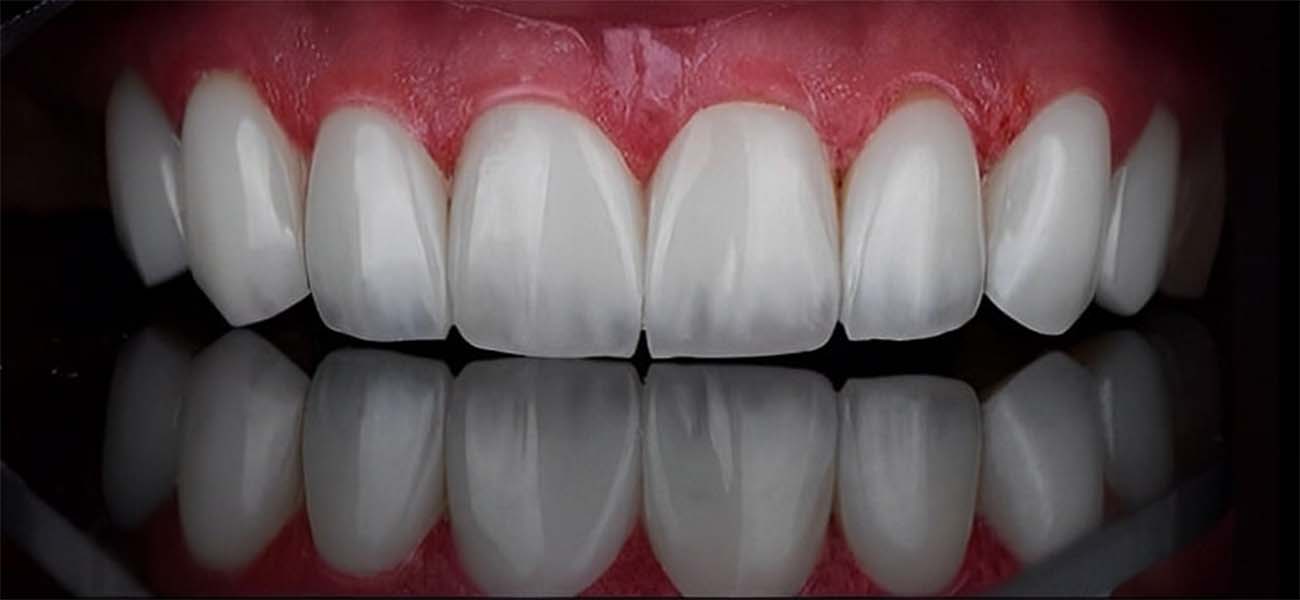 لمینت بدون تراش دندان شمال تهران